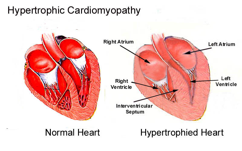 HCM